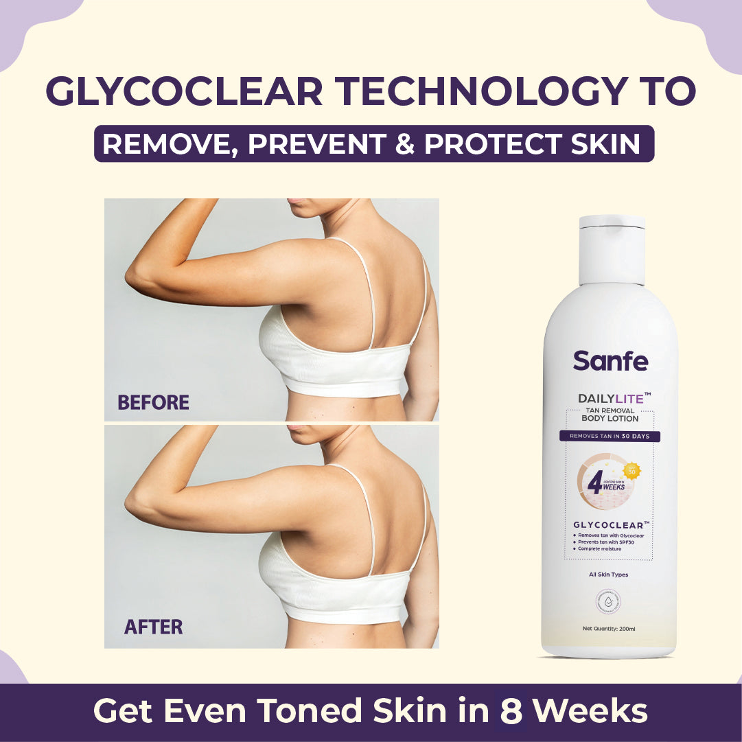 Sanfe DailyLite Body Lotion Glycopeel Technology & SPF 30 Removes & Prevents Tanning Non-Greasy Body Lotion (200)ml