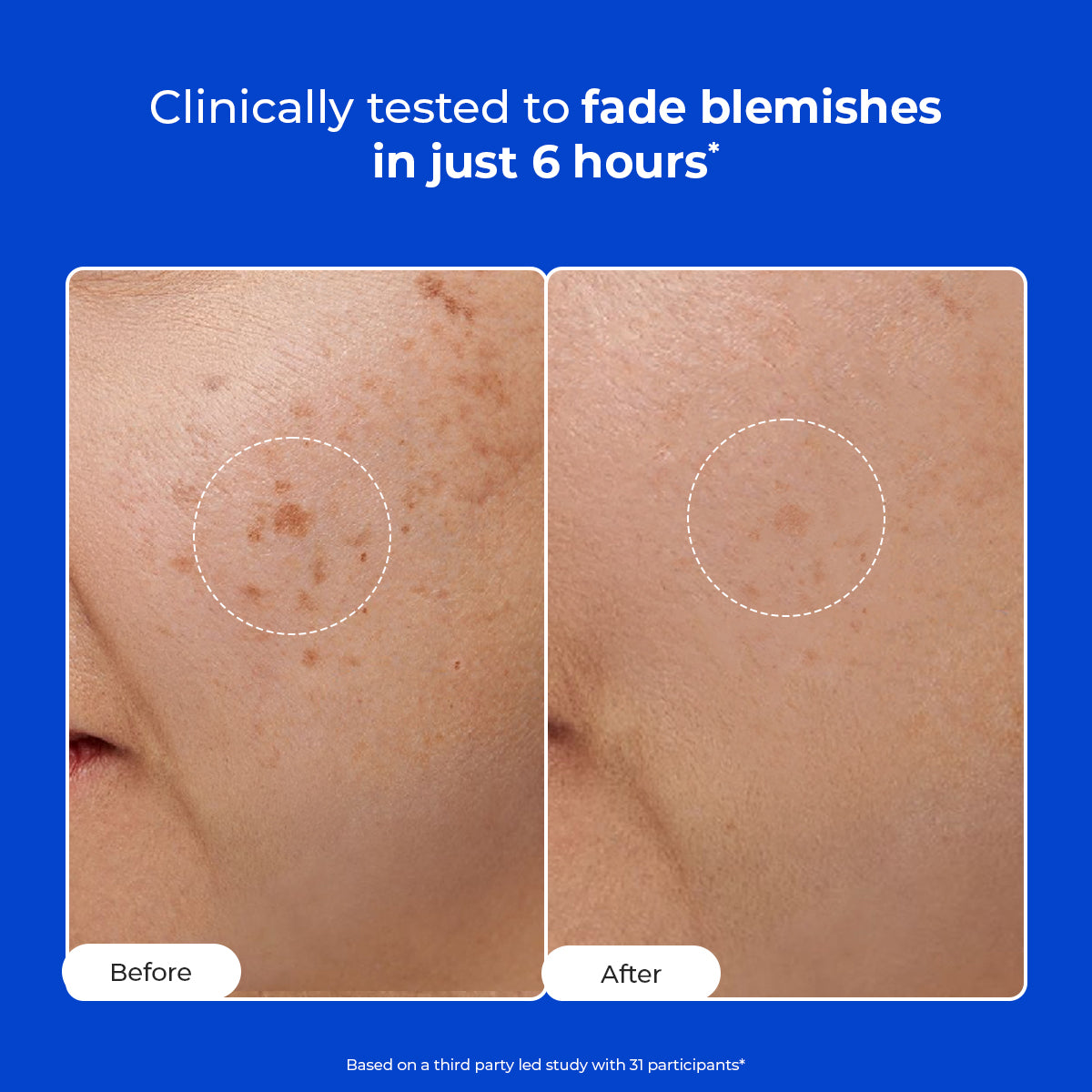 Conscious Chemist Dark Spot Lightening Microneedle Patches to Fade Dark Spots & Even Tone