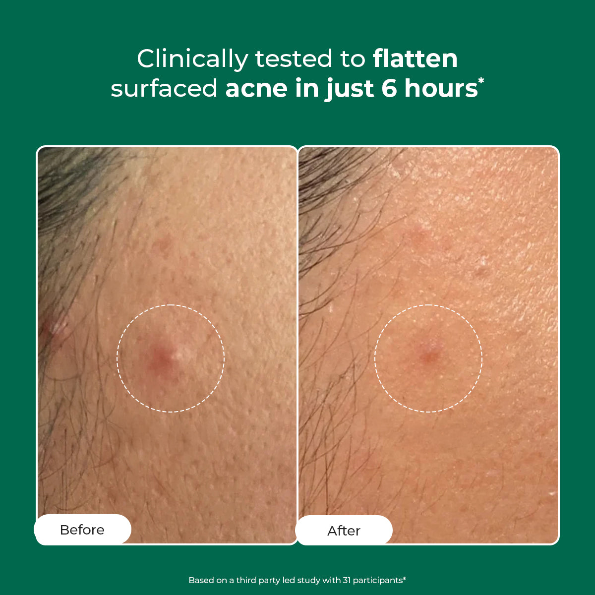 Conscious Chemist Self Dissolving Microneedle Acne Patches | Kills Bacteria & Reduces Redness