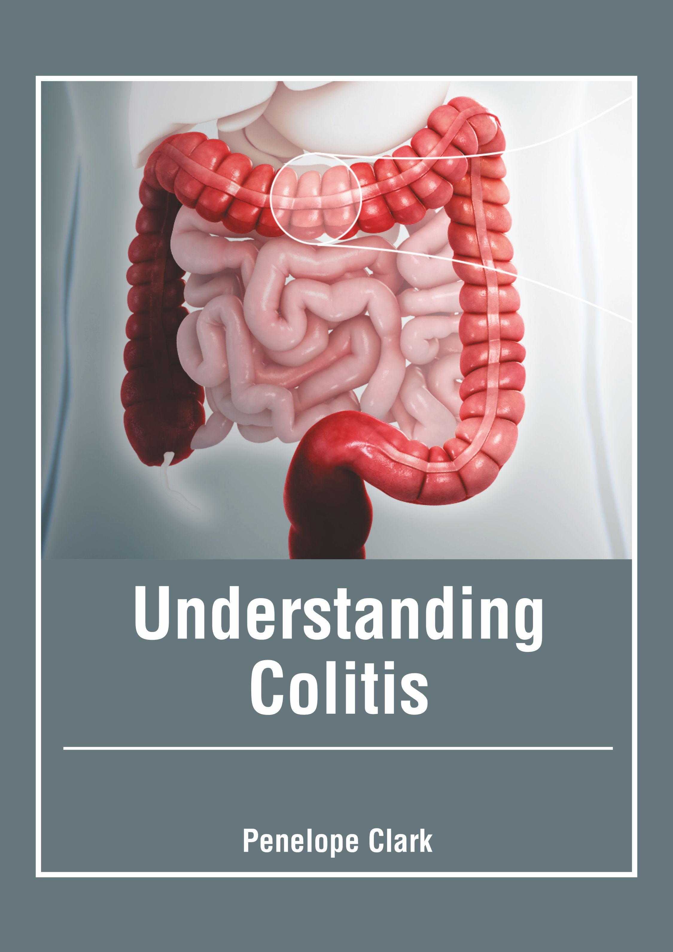 Understanding Colitis - Prints Publications