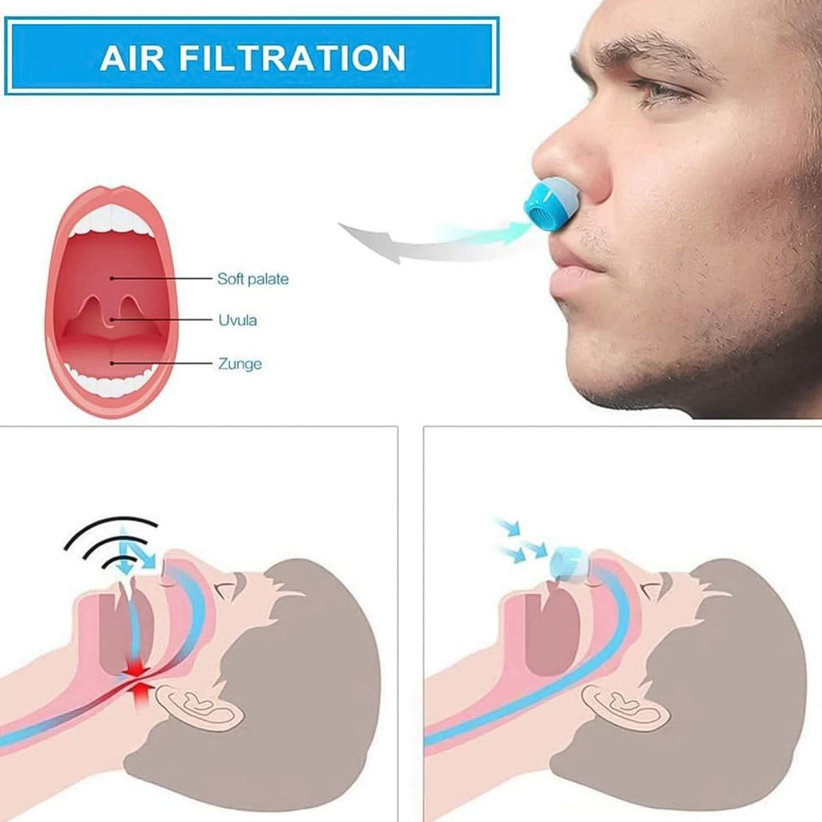 2 In 1 Anti Snoring And Air Purifier Nose Clip Anti Snoring Device (1 Pc With Plastic Case) HP DD
