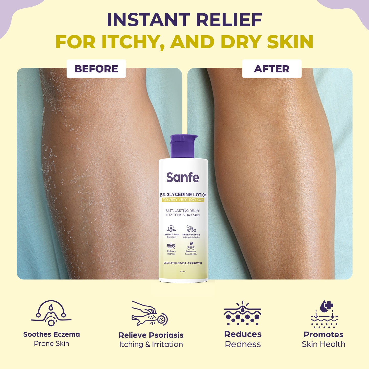 Sanfe 15% Glycerine Lotion For very very dry skin Soothes Eczema, Relieve Irritation & Itching, Reduces Redness Rapid Relief Formula - 100ml
