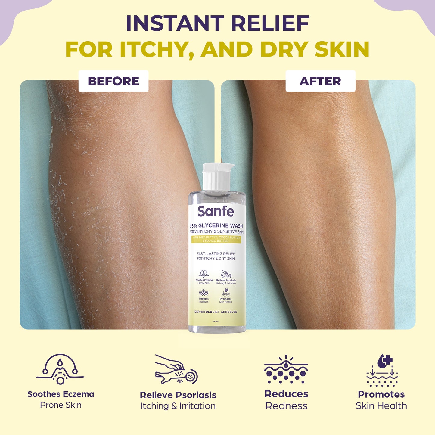 Sanfe Eczema Relief Wash | For very very dry skin | Soothes Eczema, Relieve Irritation & Itching, Reduces Redness | Rapid Relief Formula - 100ml