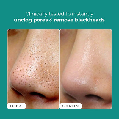 Blackhead Melting Water mini | Flash Sale