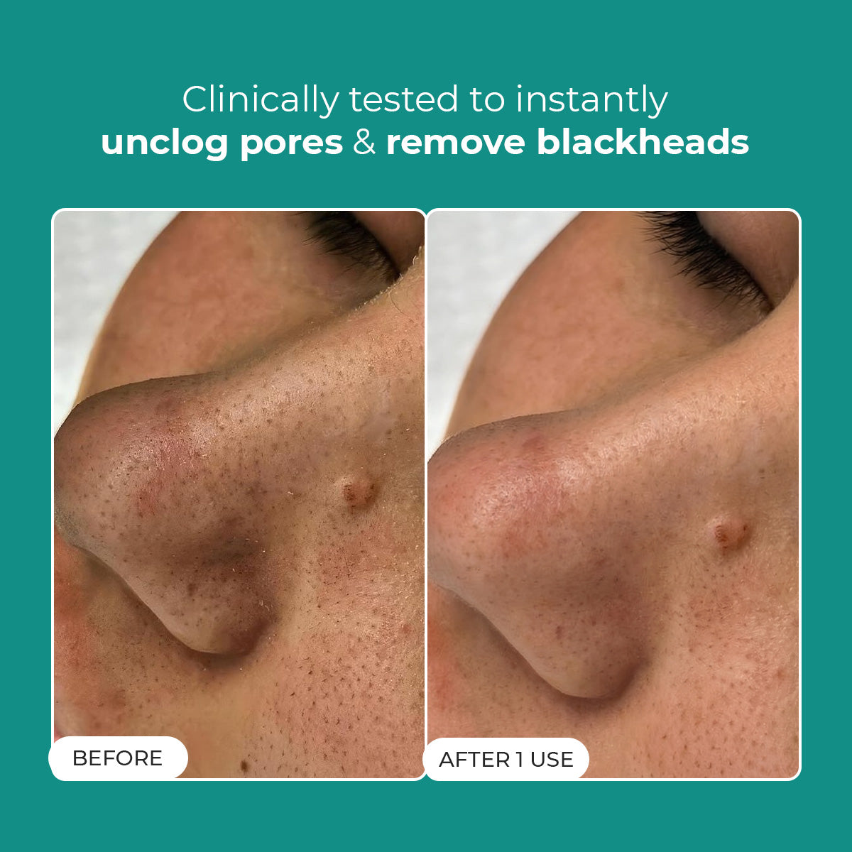 Conscious Chemist Blackhead Melting Water | Succinic, Glycolic Acid & CICA Exosome | Smooth Pores Men & Women (50 ml)