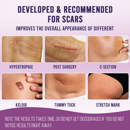 Sanfe Silicone Scar Sheet Prevent new & treat old scars Reduces redness, reusable No side effects 2 sheets, For men & women