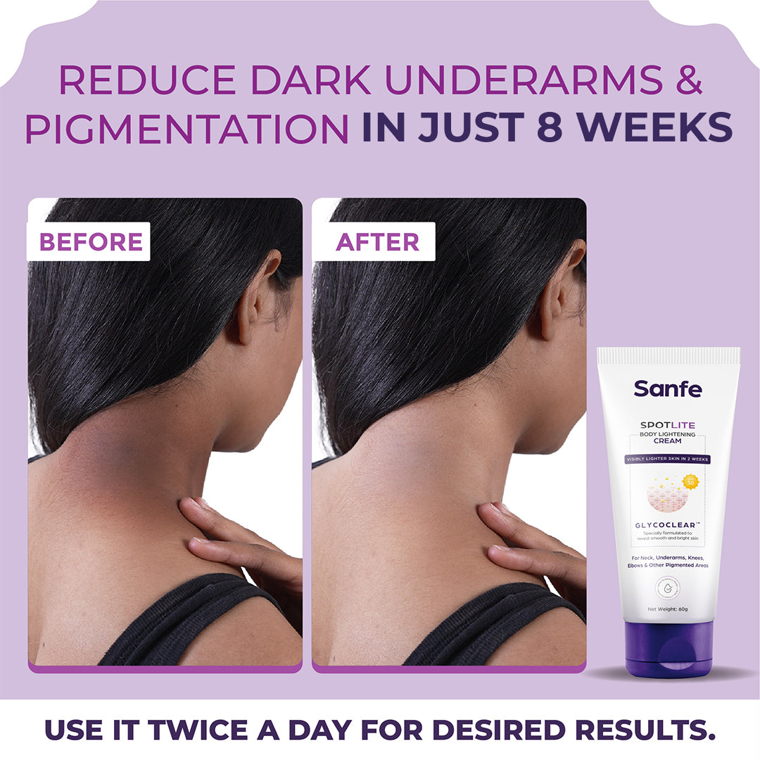 Sanfe Spotlite Body Cream For Dark Neck, Joints and Skinfolds Enriched with 3% Lactic Acid, Retinol & SPF 15 For Dark Patches, Detanning, Anti Aging and Skin Tightening Helps in Exfoliation, Lightening & 24 Hr Long Moisture - 60gm | For Indian Skin