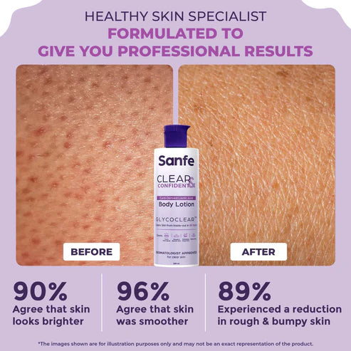 Sanfe Clear & Confident Glycolic Acid Body Lotion