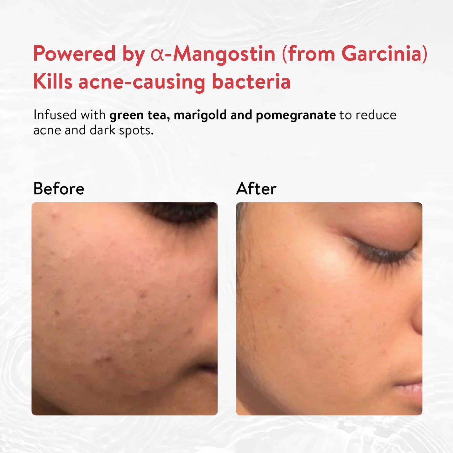 Ayouthveda Acne Enemy Face Wash Gel Pack of 3 (100 ml) Aimil Ayouthveda