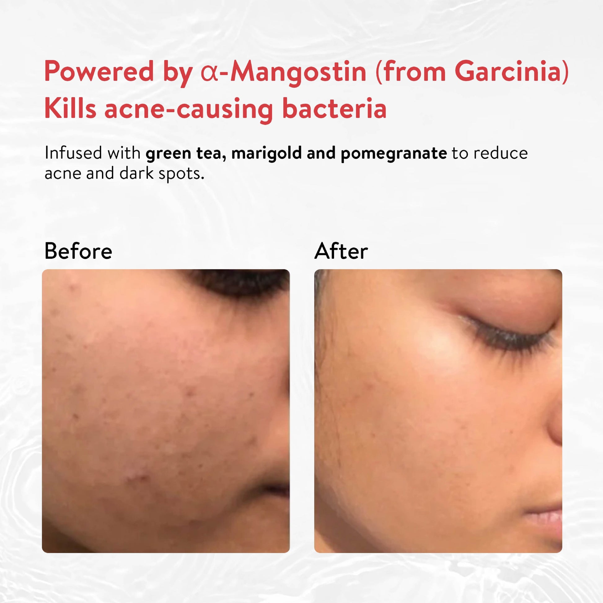 Ayouthveda Acne Enemy Face Wash Gel Pack of 3 (100 ml) Aimil Ayouthveda