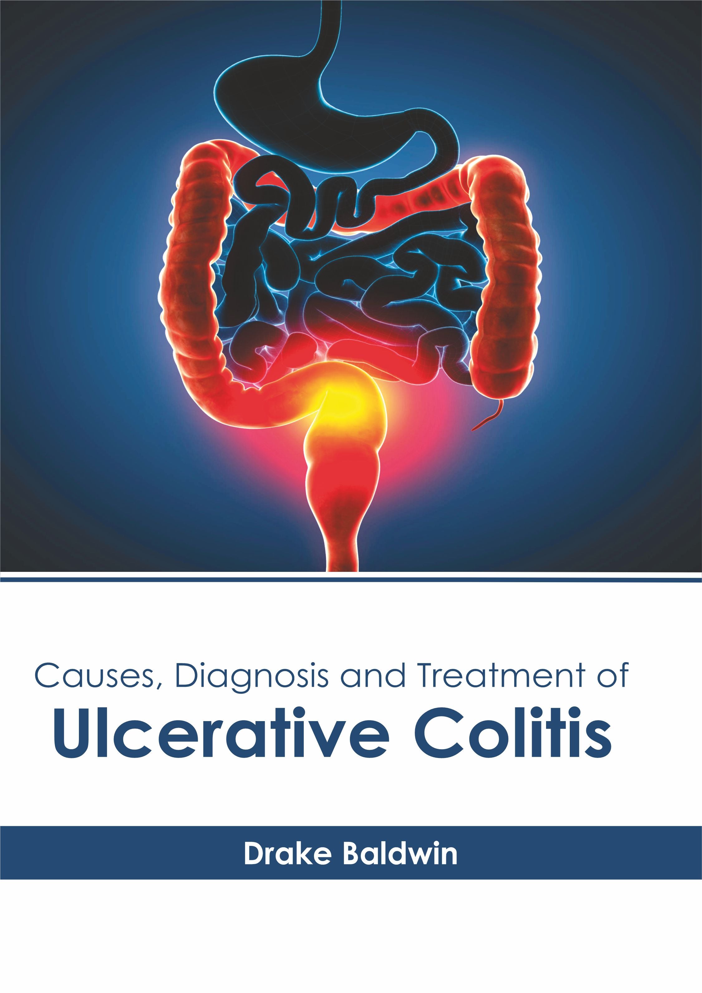 Causes, Diagnosis and Treatment of Ulcerative Colitis - Prints Publications