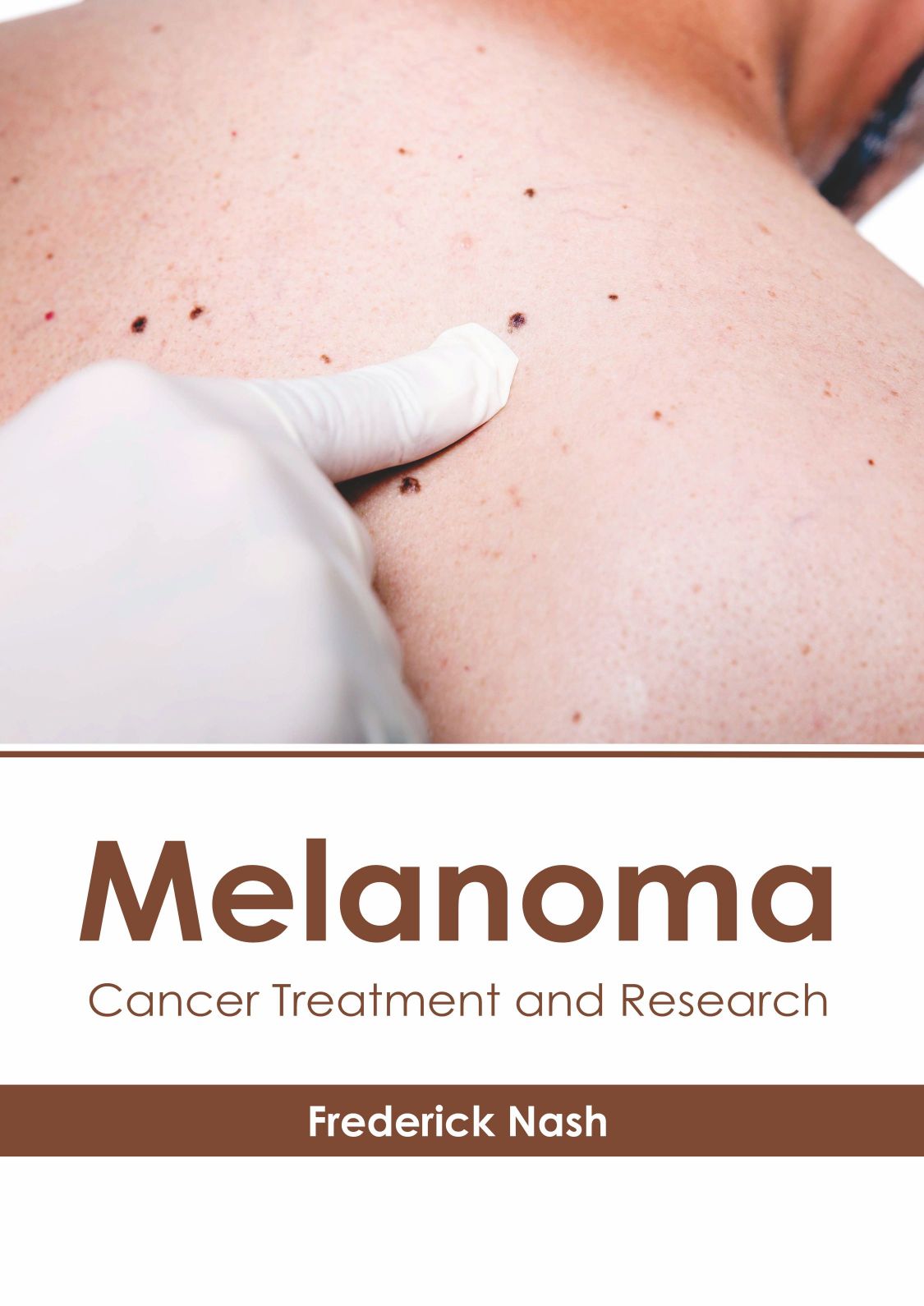 Melanoma: Cancer Treatment and Research - Prints Publications