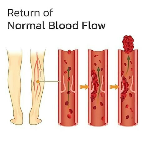 Varicose Veins Relief Patches Reduce Swelling, Improve Circulation & Soothe Leg Pain (12 Pcs)