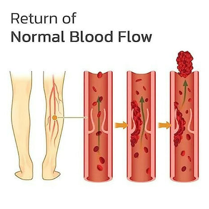 Varicose Veins Relief Patches Reduce Swelling, Improve Circulation & Soothe Leg Pain (12 Pcs)