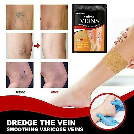 Varicose Veins Relief Patches Reduce Swelling, Improve Circulation & Soothe Leg Pain (12 Pcs)