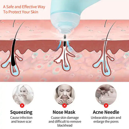 Mini Blackhead Remover Vacuum for Skin Care