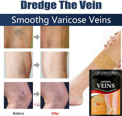 Varicose Veins Relief Patches (12 Pcs) – Herbal Pain Relief & Circulation Support