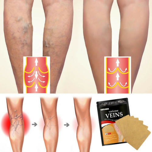 Varicose Veins Relief Patches (12 Pcs) – Herbal Pain Relief & Circulation Support