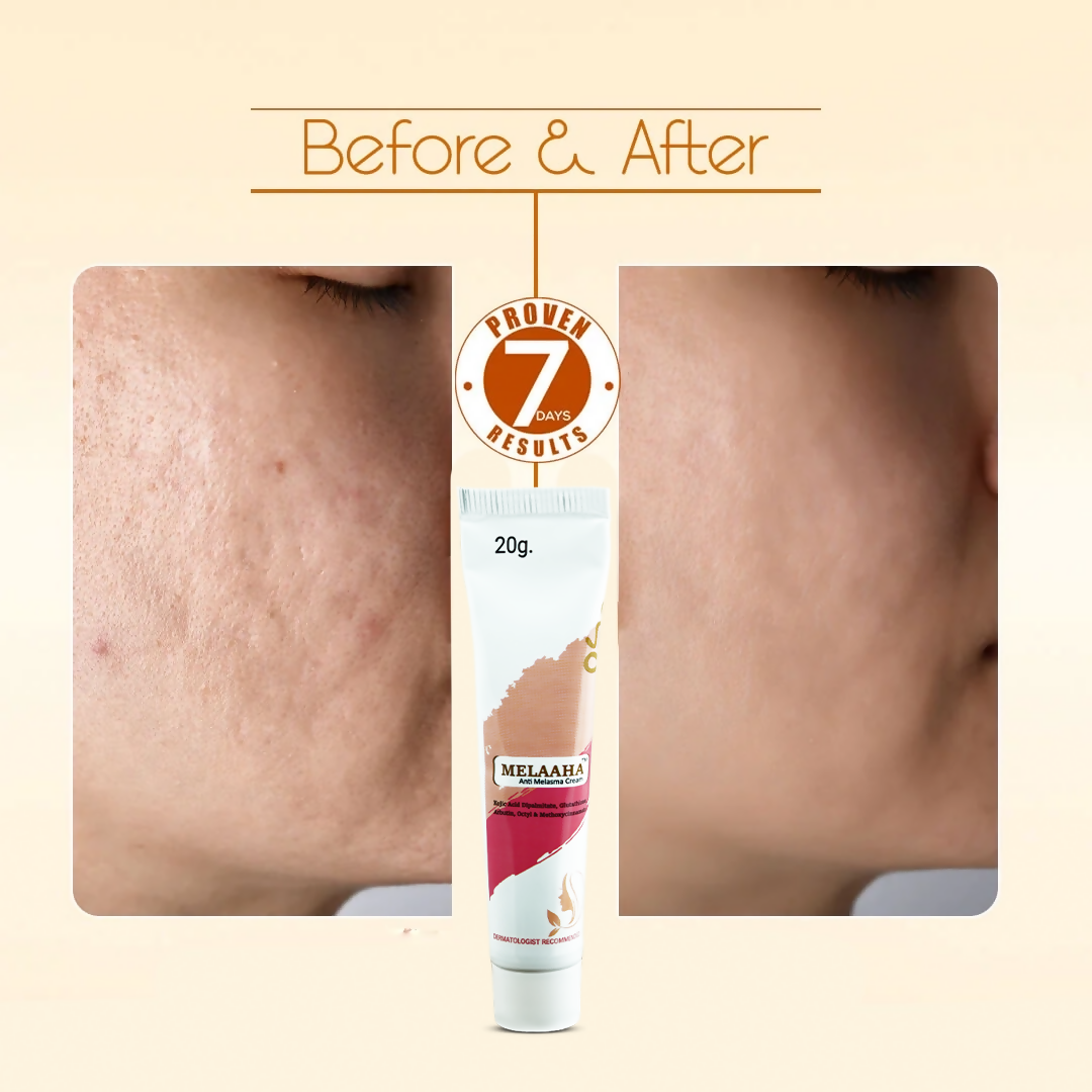 MELAAHA™ Anti Melasma Cream (20g)